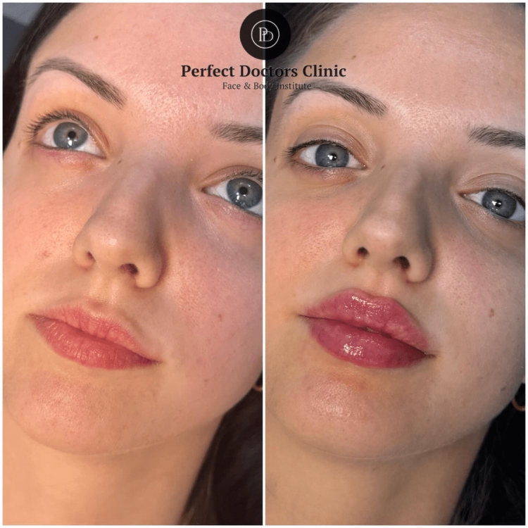 Dermal fillers in Dubai: Can They Replace Surgical Procedures?