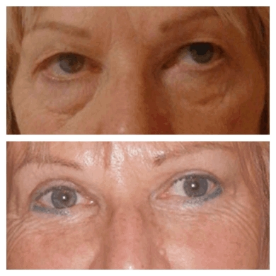 How to Minimize Scars from Eye bag removal Surgery in dubai